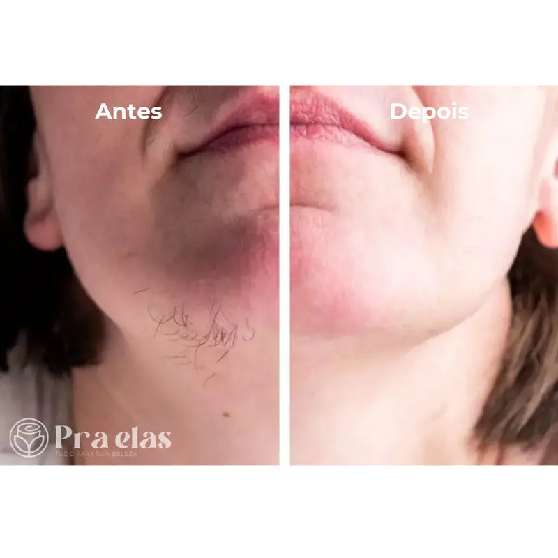 [COMPRE 1 LEVE 2] Kit Beleza - Canetas Depiladoras Facial & Corporal + Sobrancelha
