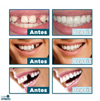 (Compre 1 Leve 2) Lente Dental Ajustável - Inferior e Superior | BRINDE CAPINHA PROTETORA + FRETE GRÁTIS!
