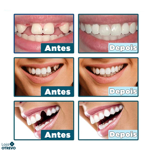 (Compre 1 Leve 2) Lente Dental Ajustável - Inferior e Superior | BRINDE CAPINHA PROTETORA + FRETE GRÁTIS!