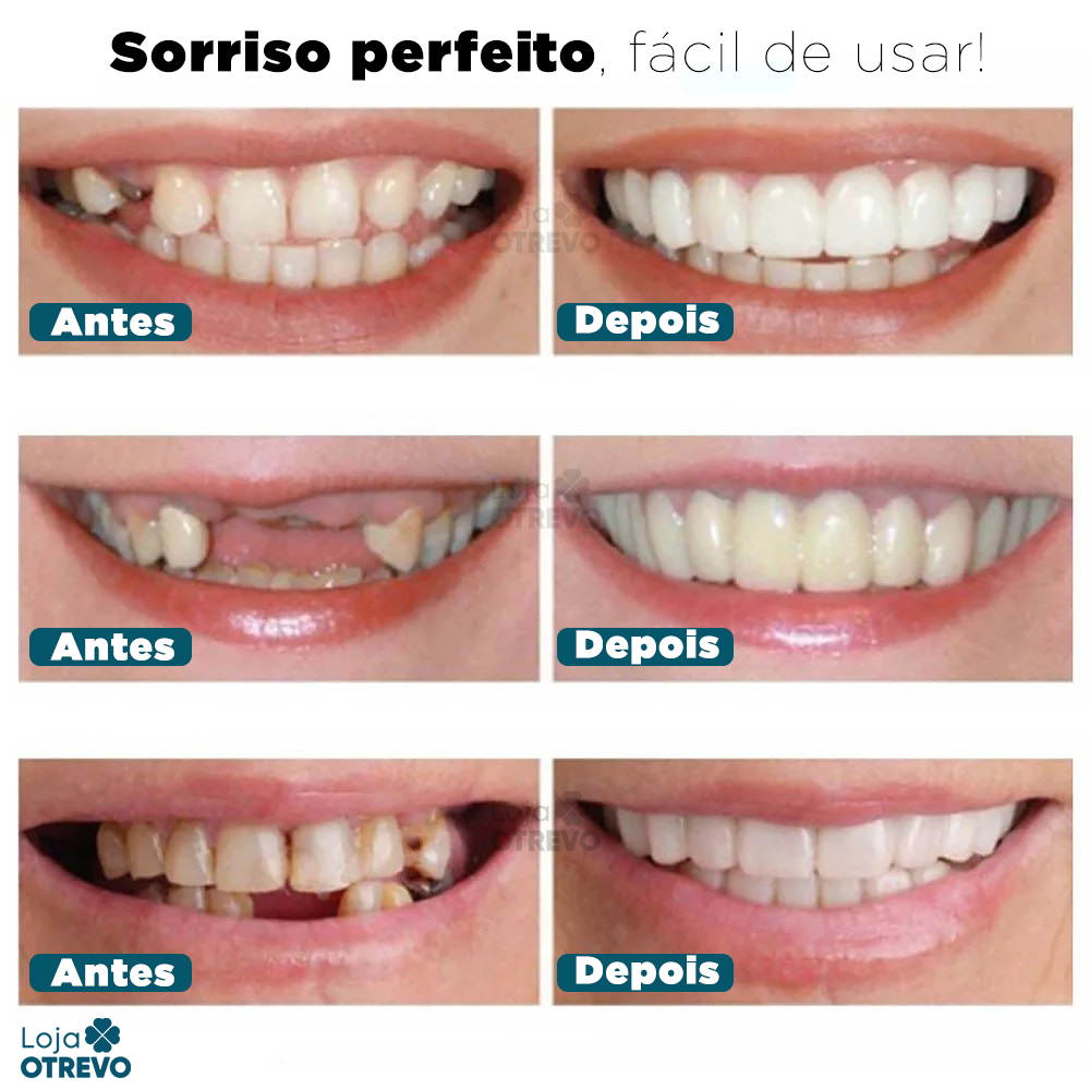 (Compre 1 Leve 2) Lente Dental Ajustável - Inferior e Superior | BRINDE CAPINHA PROTETORA + FRETE GRÁTIS!